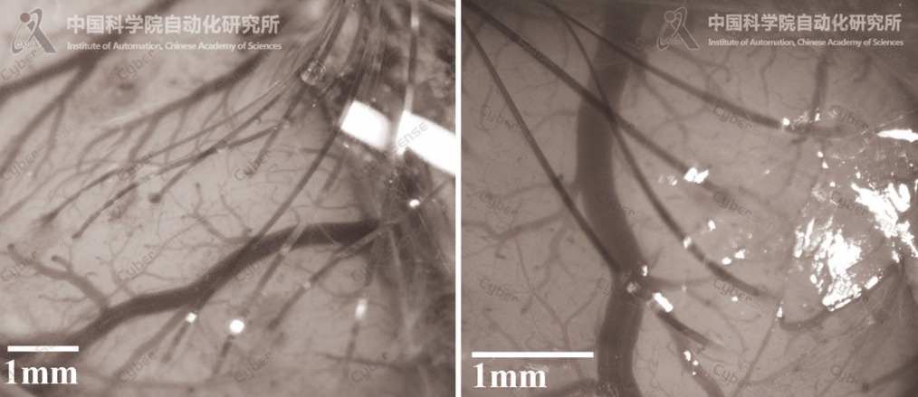 neurochip in brain